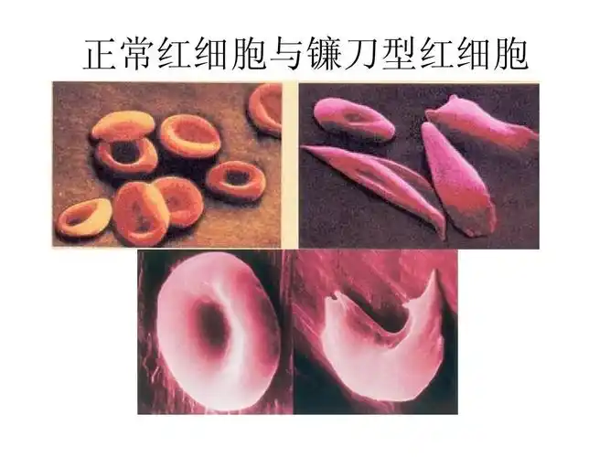 正常白红细胞与镰刀型红胞 细