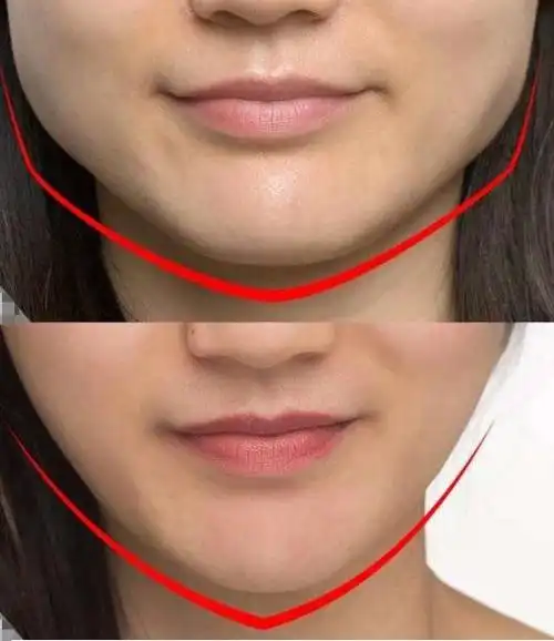 青春期方脸怎么变瓜子脸,如何改善方脸变成瓜子脸(5个妙招让你分分钟