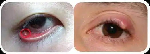 娃得麦粒肿,这些"土办法"不能信_眼睑_孩子_炎症