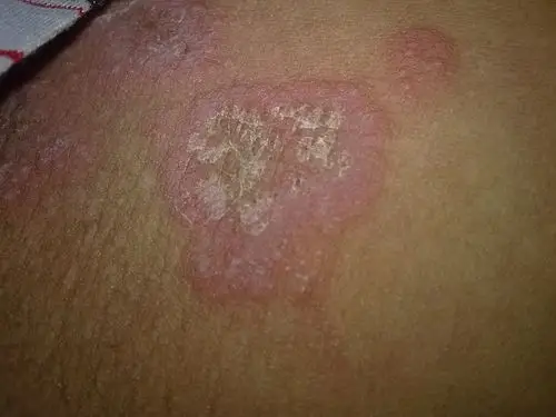 大腿内侧阴囊边上有一片凸起