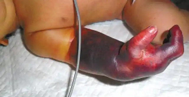 宝宝出生三天, 只因一时疏忽就要"截肢"