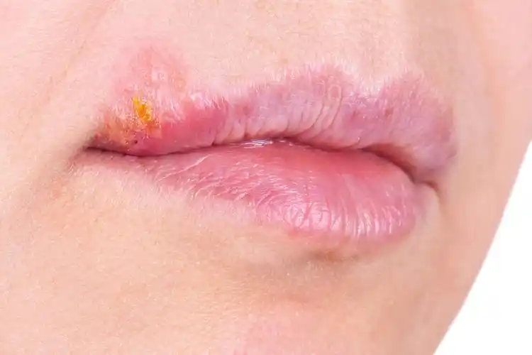 其实嘴角长泡可能是单纯疱疹病毒(hsv-1)感染引起的症状.