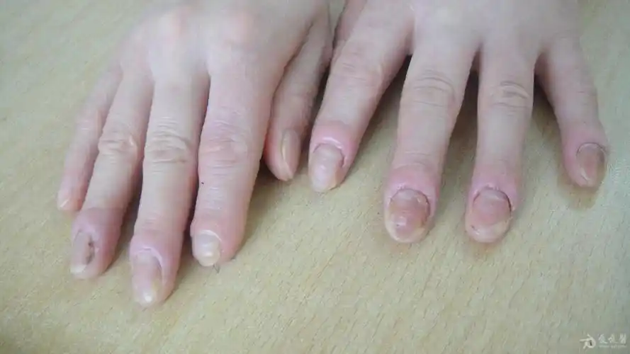 今日病例3--念珠菌性甲沟炎