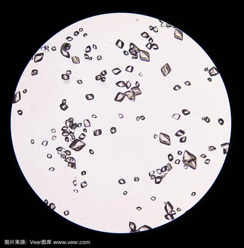 尿沉淀物中的尿酸结晶.