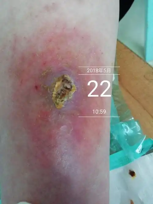 伤口结痂就一定愈合了吗?