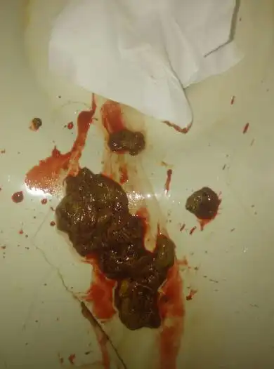 拉大便拉出血,血量大严重吗?什么原因引起的.20岁男