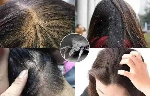 头皮出现了这些油腻腻,恶心的泥状物,就说明头上长了螨虫!