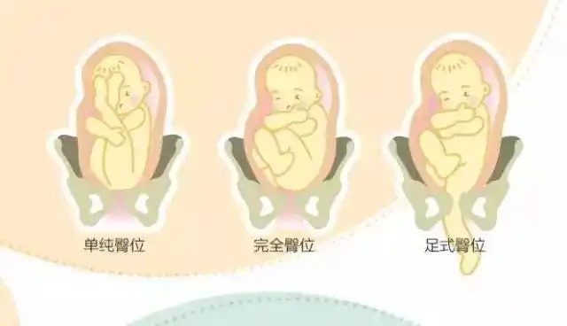 孕妈妈妊娠28周时,约有75%的胎儿会以头部朝下的姿势为诞生做准备,最