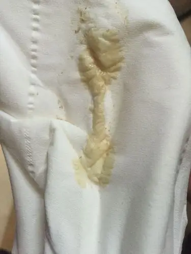 不来事,总流白带颜色黄还带血不知道怎么回事也快有五六天了白带有