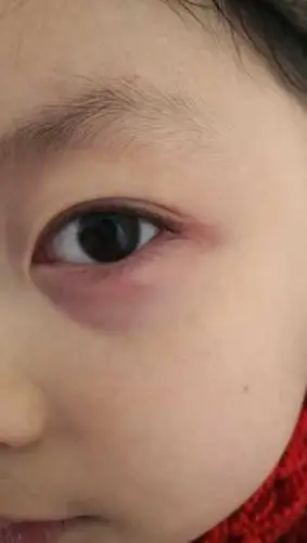 孩子下眼睑像起了个包,下眼皮红