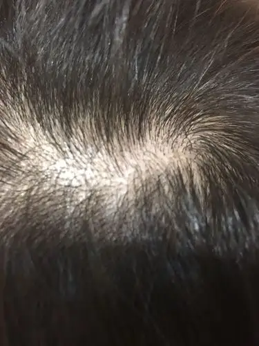 很容易油,有疙瘩,有卵白在发根,指甲对挤很软的样子,就像头皮屑一样