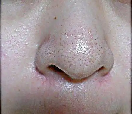 鼻子毛孔大?简单秘方,让你告别"孔"慌,恢复光滑肌肤!