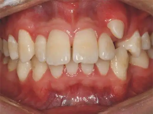 虎牙矫正会影响颜值吗?