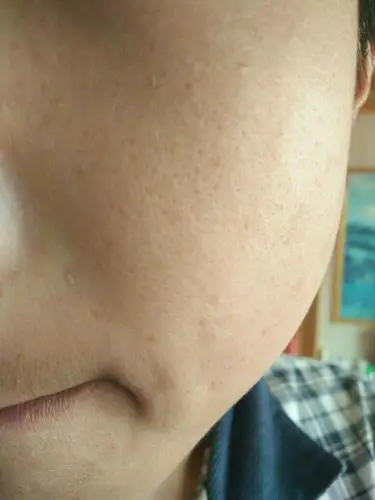 我这个皮肤怎么改善,毛孔粗大,洗完脸干