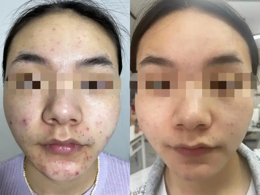 019969♀15鲜鲜出炉皮肤对比图一组 痘痘其实都是小问题,只