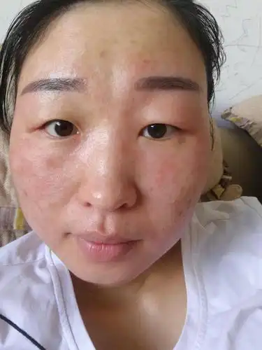 脸油到底是什么原因导致的