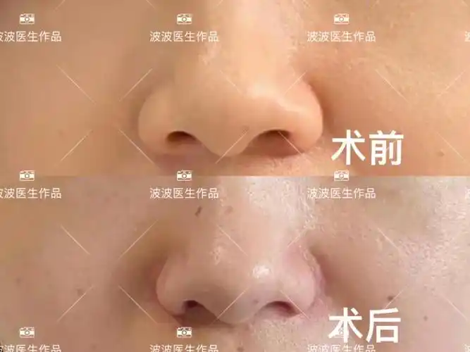 鼻翼缩小术后两个月