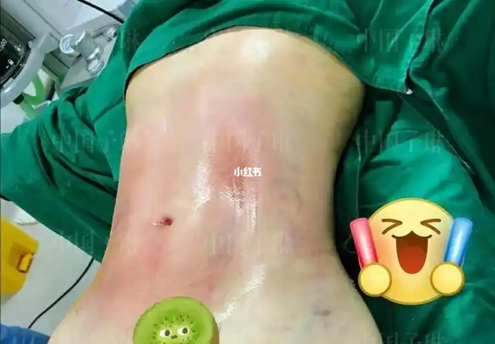 【威塑腰腹环吸】 塑形 rf,一举两得:不只瘦,还要s曲线,术前精确测量