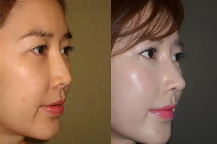 韩国可安美整形医院脂肪填充案例