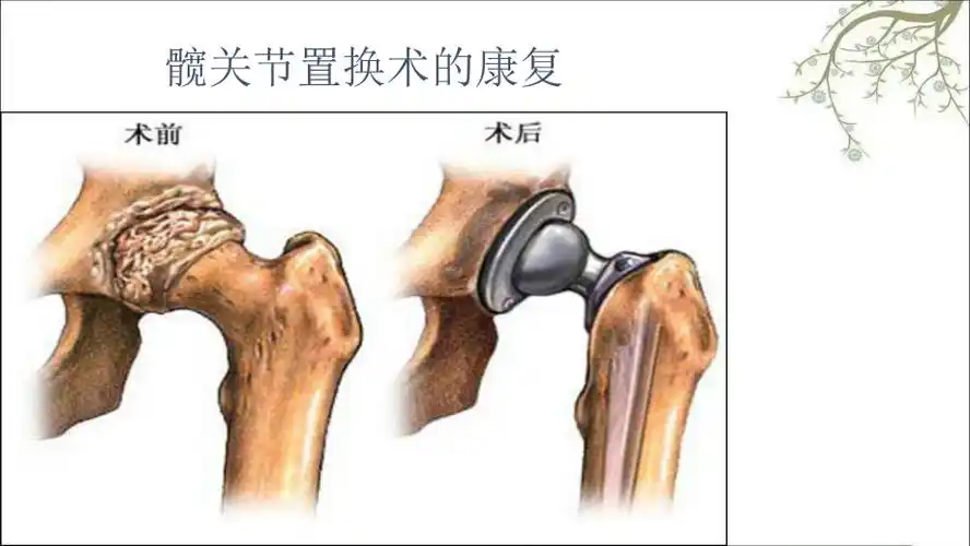 髋关节置换术的康课件