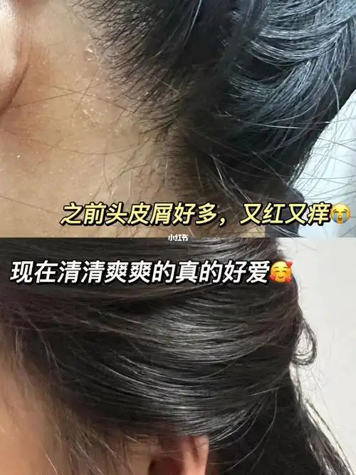 敏感头皮速进!拜托你们用舒蕾 pro家的洗护