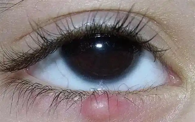 当心!眼睑出现这种症状,可能是大病征兆!_治疗