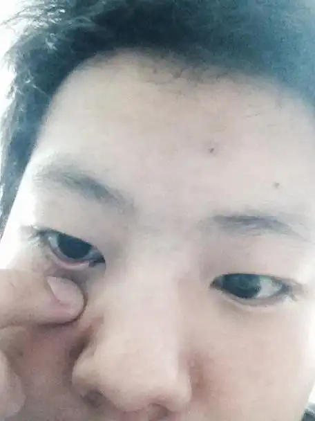 请问手术去掉这下眼睑的痣有没有风险,因为激光去这痣很容易伤到眼睛