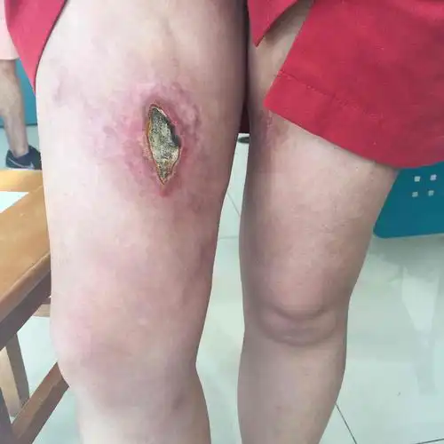 我看到的下图很明显,抽脂区域已经感染并呈现坏死性筋膜炎的外观了