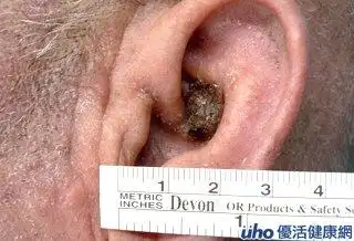 耳廓上的恶性肿瘤图片 (第1页)