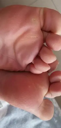 前脚掌磨有茧子,你们一般怎么处理?(配图不忍直视,胆小勿进)