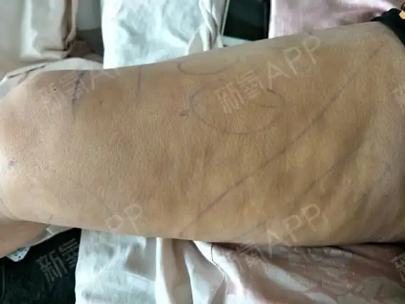 大腿凹凸不平好烦现在抽脂第十天