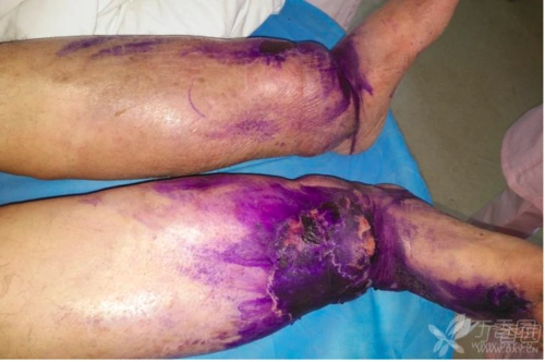 双下肢肿胀如象腿,这是什么病?