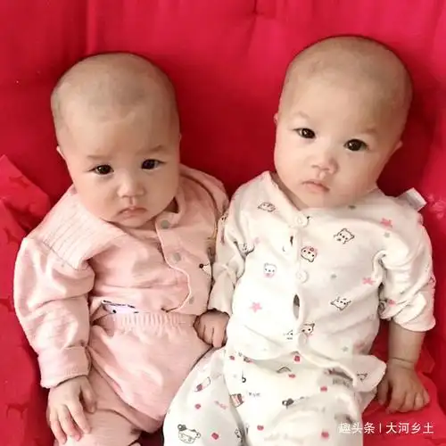 小女儿被开水烫伤面目全非母亲每天内疚自责孩子都是我的错