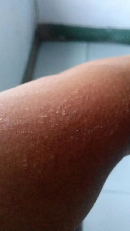 胳膊这是晒伤了吗 该怎么办 好痒