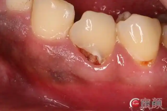 分享一组双尖牙根面龋补牙案例