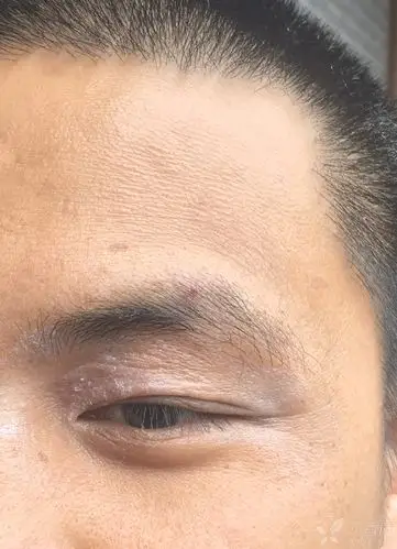 上眼睑皮肤脱皮 - 皮肤与性传播疾病讨论版 -丁香园论坛