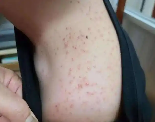 背上长痤疮可能是马拉色菌感染毛囊炎治疗需要注意