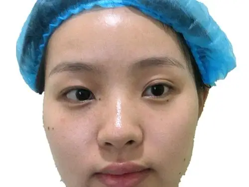 一直以来看起来都很奇怪,所以做了很久的思想斗争,决定做一下双眼皮