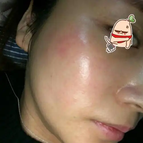 激素脸症状表现 1,出现多种皮肤问题 像是痘痘,粉刺,痤疮等同时出现