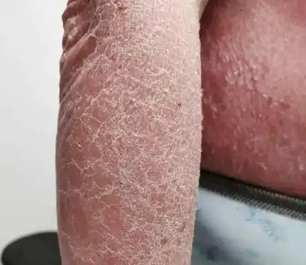 其症状主要为皮肤发紧,个别部位干燥脱皮,洗澡过后全身发痒.