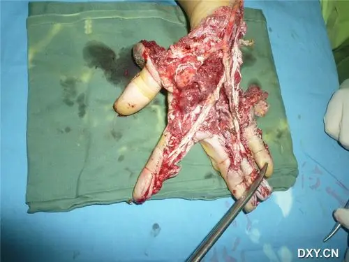 急诊修复棉花机蹂躏下的手 [精华]