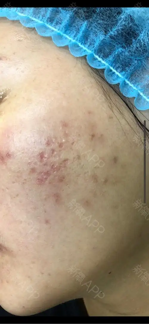 事隔一月第二次做水杨酸 果酸点涂啦!