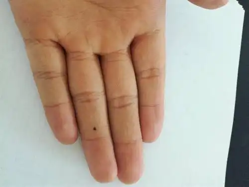 去年开始我左手无名指长了一颗痣,这有什么说法吗