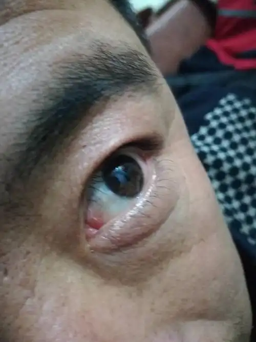 这是怎么了,黑眼球旁边长了个白色疙瘩,现在爸爸45岁