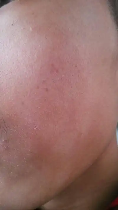 脸上长癣图片 (14)_有来医生