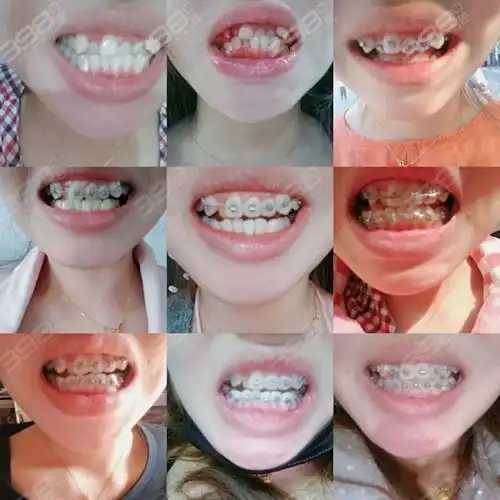 带牙套112月变化图矫正效果堪比整容居然改变了脸型