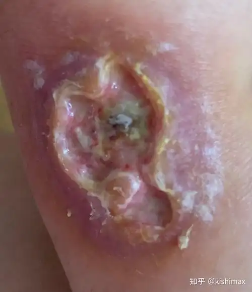 烫伤恢复过程(深二三度,腿部小部位烫伤)烫伤康复日记