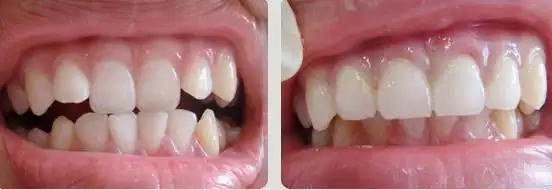 儿童虎牙矫正前后对比