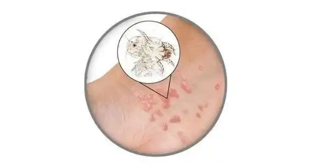 疥疮是单个还是成片出现呢?有没有什么规律?_症状_疥虫_进行