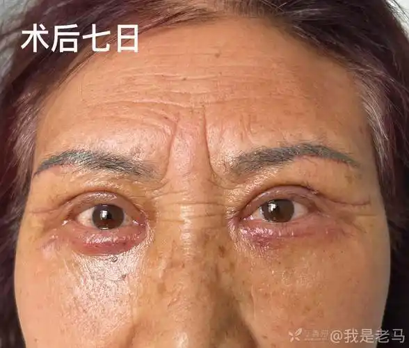 中老年重睑十八联合切眉